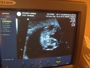 Second ultrasound - heartbeat up to 164bpm!
